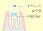 軽度のむし歯（C1）