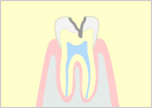 中度のむし歯（C2）