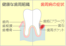 歯周病治療