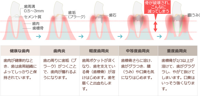 歯周病の進行